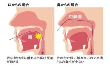 鼻から入れる胃カメラ