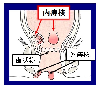 内痔核と外痔核