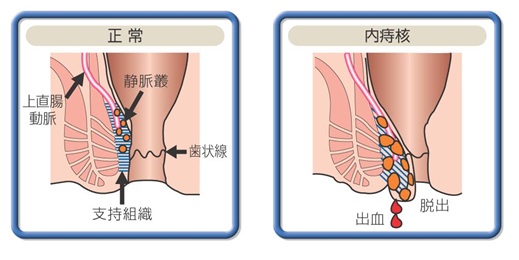 内痔核