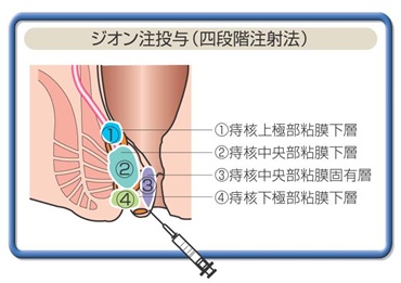 ジオン式4段階投与