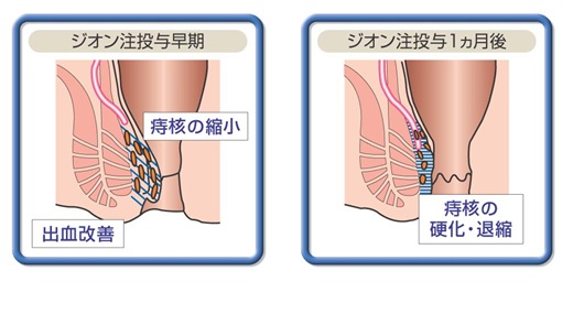 ジオン式手術後