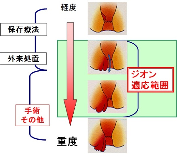 ジオン式適用範囲