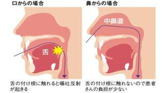 鼻からの場合、舌の付け根に触れないので患者さんの負担が少なくなりやすい